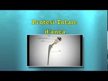 Video informativo sull'intervento di protesi totale d'anca