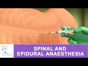 SPINAL & EPIDURAL ANAESTHESIA