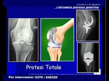 il Medico e il Cittadino - Puntata 25 - L'Ortopedia di San Clemente - 2/2