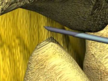anestesia spinale